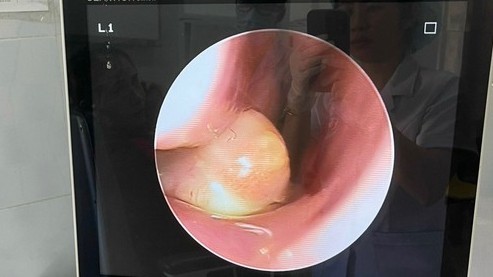 Ca bệnh hi hữu, trẻ 4 tuổi mọc răng trong khoang mũi