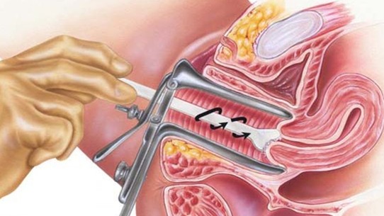 Ung thư cổ tử cung có thể tầm soát sớm?