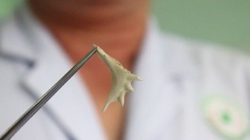 Suýt thủng ruột vì nuốt phải xương cá nhiều góc cạnh