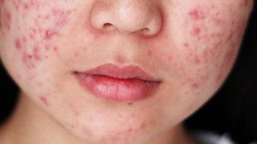 4 dấu hiệu trên khuôn mặt cảnh báo gan đang kêu cứu