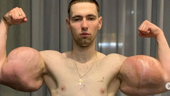 Bơm 3 lít dầu vào tay, thanh niên 23 tuổi bị thối hết cơ bắp