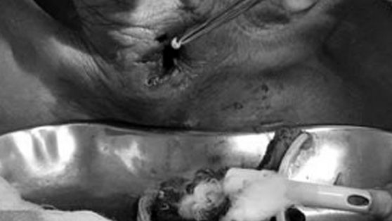 Bác sĩ rùng mình gắp 30 con giòi trong cổ bệnh nhân