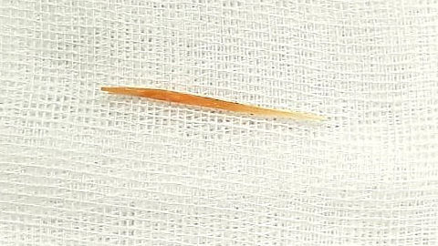 Bé gái một tuổi nuốt tăm nhọn