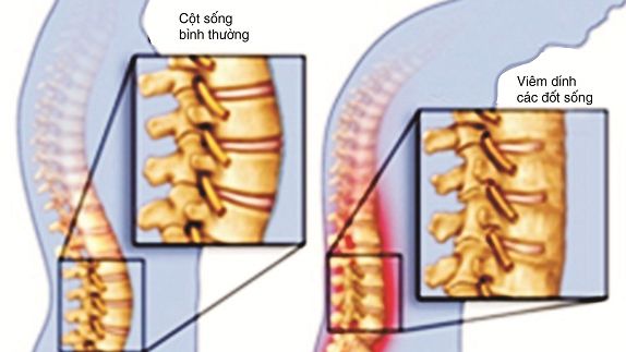 Viêm khớp cột sống dễ gây tàn phế