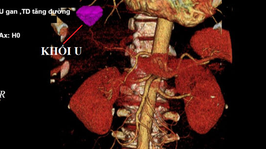 Nam thanh niên trẻ mắc ung thư gan, ân hận vì loại đồ uống mê mẩn