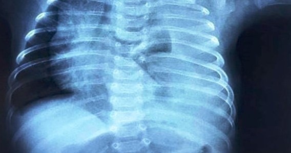 Em bé nguy kịch vì nửa lít dịch tràn vào màng phổi mỗi ngày