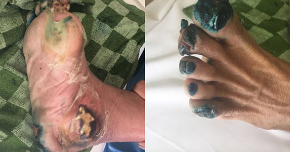 Người đàn ông Quảng Ninh phải cưa chân hoại tử, bốc mùi do chủ quan