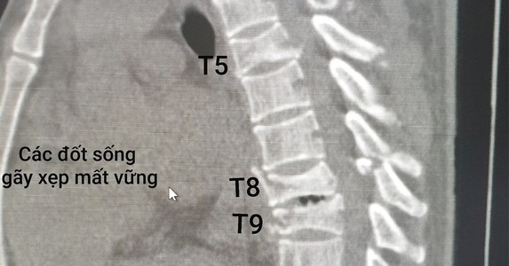 Vật nặng rơi trúng đầu, ngực người đàn ông suýt liệt toàn thân
