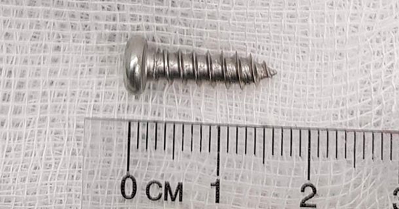 Hai em bé nuốt đinh vít, chìa khóa