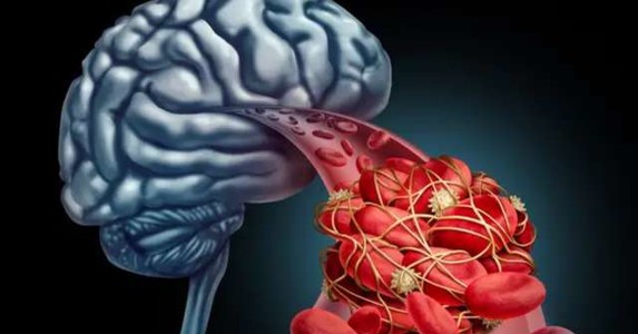 Nhồi máu não đến quá nhanh, nhận biết được 5 triệu chứng sẽ tự cứu sống mình