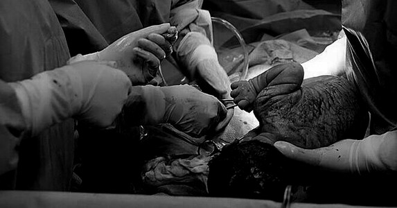 Cứu thai nhi trong bụng người mẹ bị tai nạn giao thông