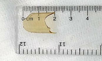 Bé gái nuốt mảnh thủy tinh vỡ từ ống thuốc