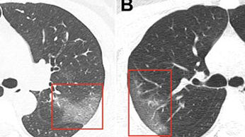 Hình ảnh phổi bệnh nhân nhiễm Covid-19 bị virus Corona tàn phá