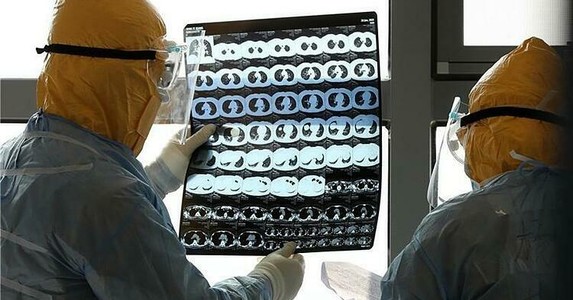 Lần đầu phát hiện nCoV trong não tủy bệnh nhân