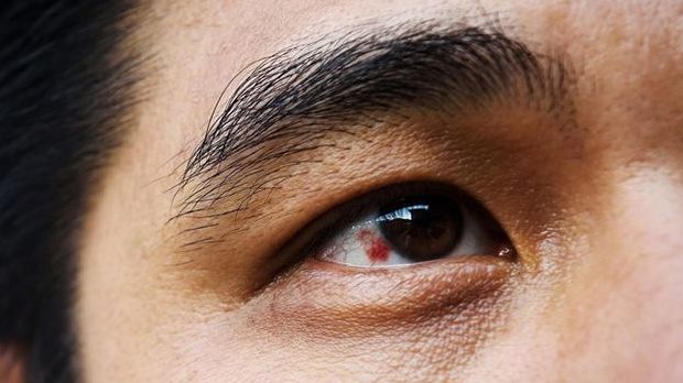 3 đốm đen xuất hiện trên cơ thể cảnh báo bệnh nhồi máu cơ tim