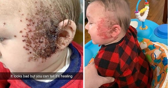 Xót xa trước hình ảnh mặt em bé nổi đầy mụn rộp do thói quen hôn hít của người lớn