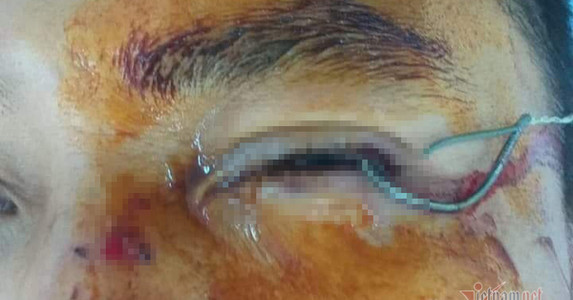 Đi câu cá, người đàn ông bị lưỡi câu móc rách giác mạc