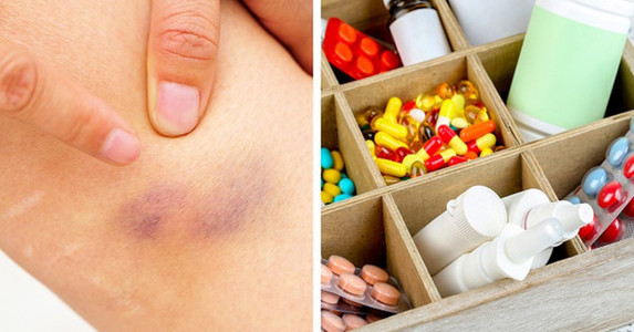 Nếu hay bị các vết bầm tím không rõ lý do, có thể bạn mắc các bệnh này