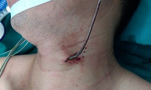 Người đàn ông bị thanh sắt đâm vào cổ do xe tải bên đường bất ngờ nổ lốp,