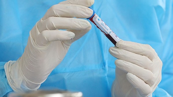 Nuôi cấy virus tìm nguyên nhân 5 bệnh nhân tái dương tính