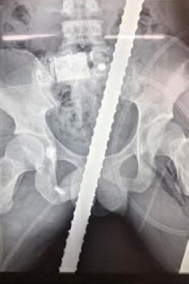 Cứu sống thanh niên bị 2 thanh sắt đâm xuyên tầng sinh môn, bụng, ngực, đùi