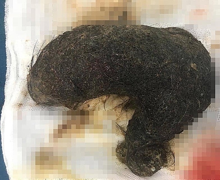 Búi tóc dày 20 cm trong dạ dày bé gái