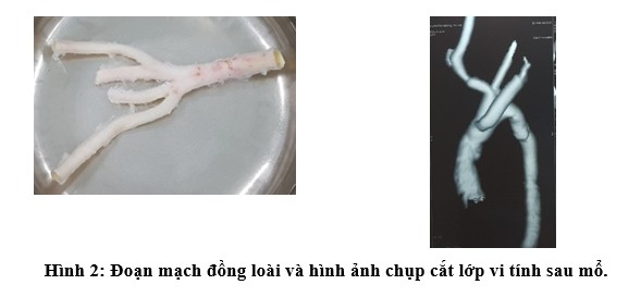 Thay quai động mạch chủ cho bệnh nhi bằng động mạch hiến tặng