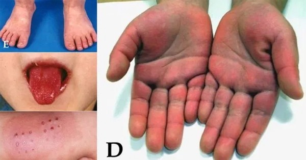 Biến chứng lạ ở ba em bé nhiễm Covid-19