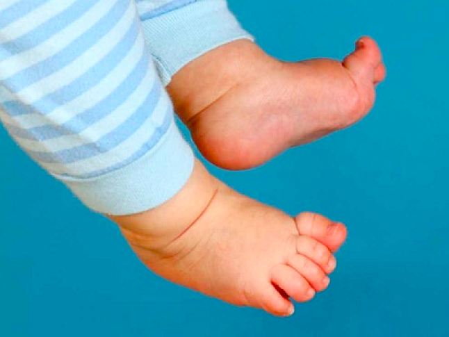 Bàn chân đổ ngoài khi trẻ nằm duỗi chân là dấu hiệu trật khớp háng bẩm sinh. Ảnh: Bác sĩ cung cấp.