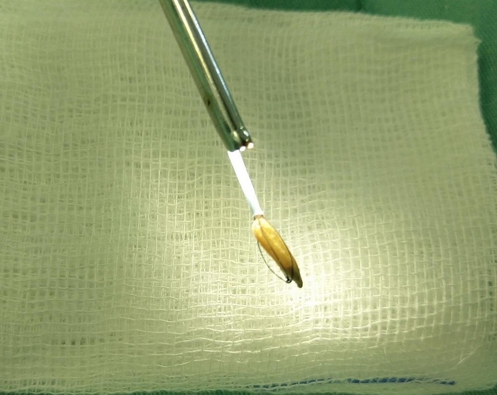 Hạt thóc chui vào dương vật