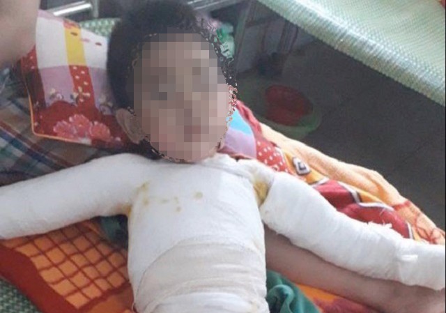 Ba lần ghép da chữa bỏng