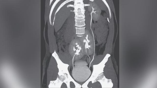 Ảnh chụp CT 3 quả thận.
