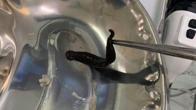 Con đỉa sống trong mũi bé gái