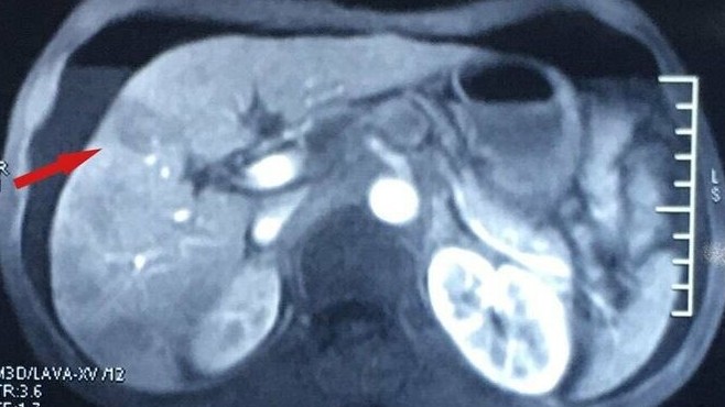 Để ung thư di căn vì mải uống thuốc nam