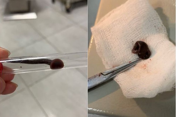 Hình ảnh con vắt vẫn đang sống được gắp ra khỏi mũi bệnh nhân