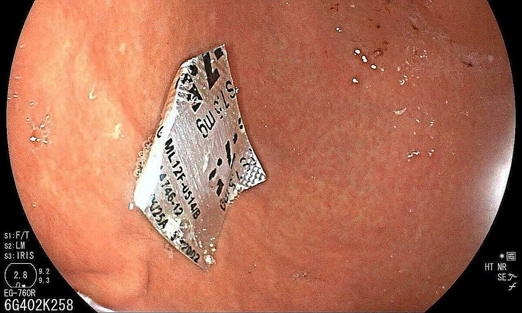 Viên thuốc nguyên vỉ trôi vào dạ dày