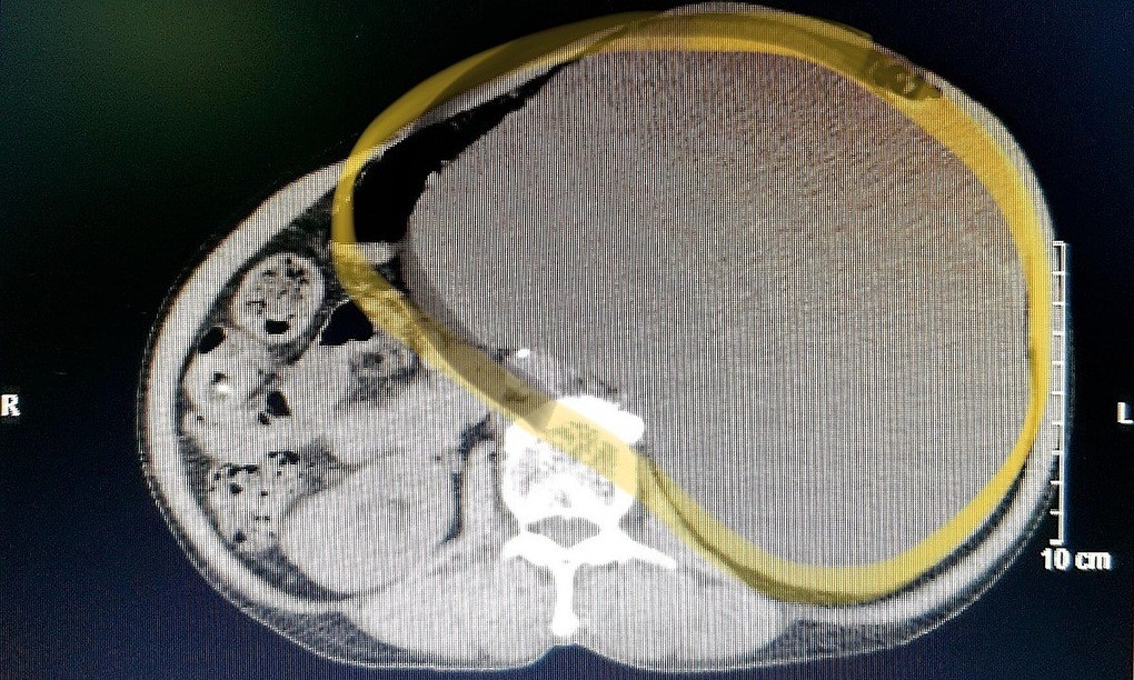 Phim chụp X-quang cho thấy kích cỡ thận trái giãn to. Ảnh: Long Nhật.