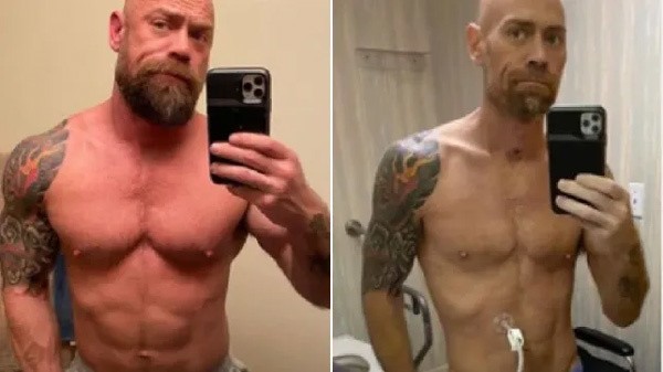 Hình ảnh trước và sau khi nhiễm Covid-19 của Mike