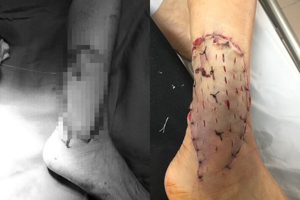 Vết thương bệnh nhân trước (trái) và sau khi được khâu lại