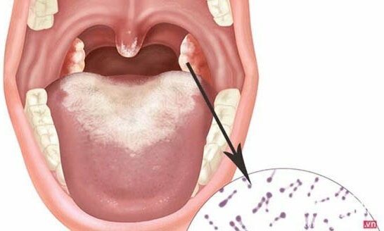 Hai thiếu niên mắc bệnh bạch hầu