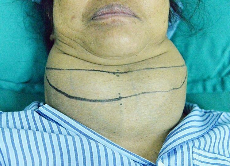 Khối bướu to như quả bưởi ở cổ