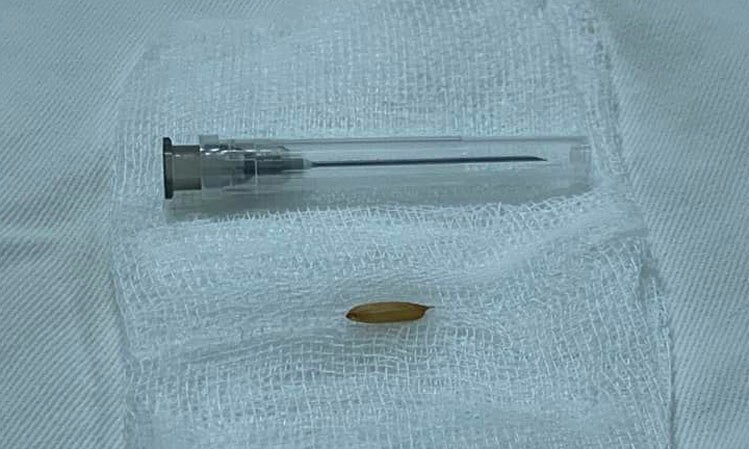 Hạt thóc trong niệu đạo bé gái