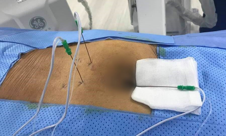 Biến chứng sau tiêm thuốc vào cột sống