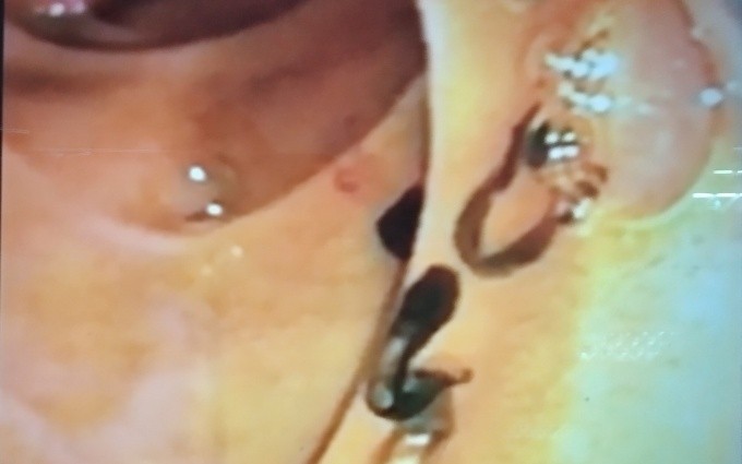 Ăn chín, uống sôi để phòng bệnh sán lá gan