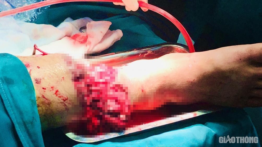 Bệnh nhân bị TNGT đứt lìa cẳng chân.