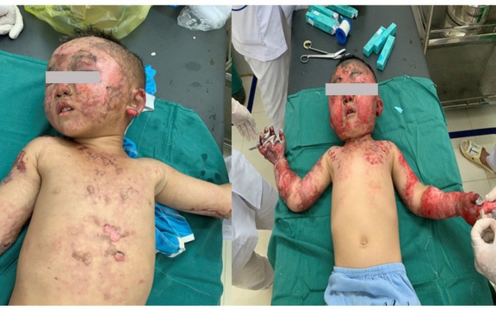 Nghịch lửa, hai bé bỏng nặng