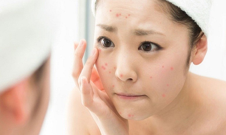 Tại sao mùa hè da dễ nổi mụn?