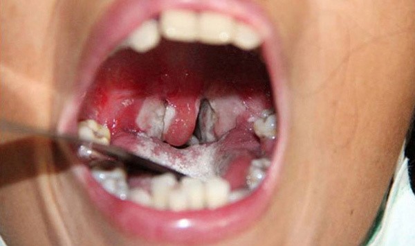 Bệnh bạch hầu có thể phòng ngừa bằng cách tiêm vắc xin