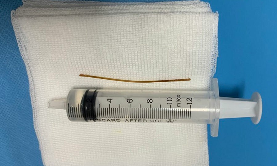 Que tăm lấy ra từ bụng của bệnh nhân. Ảnh: Bệnh viện cung cấp.