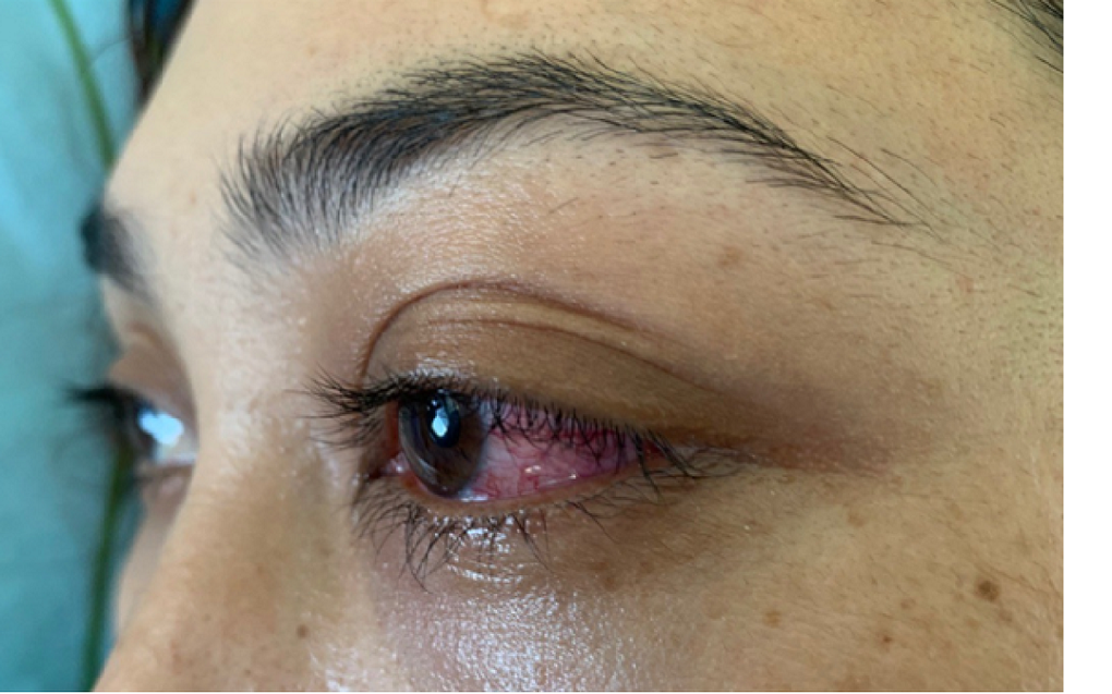 Tưởng chỉ đau mắt đỏ, thiếu phụ suýt bị mù